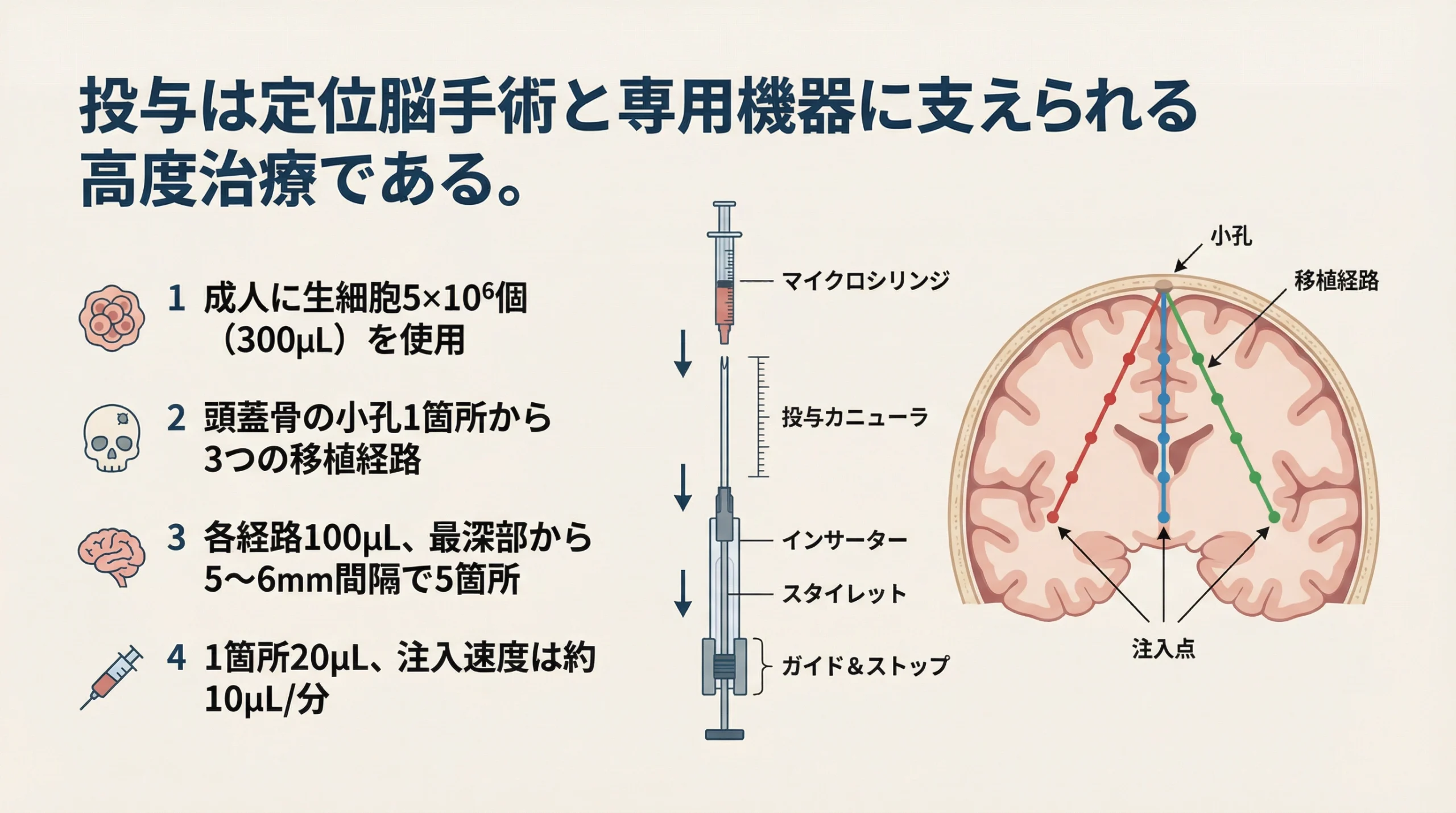 アクーゴの投与方法と定位脳手術の流れを示すスライド